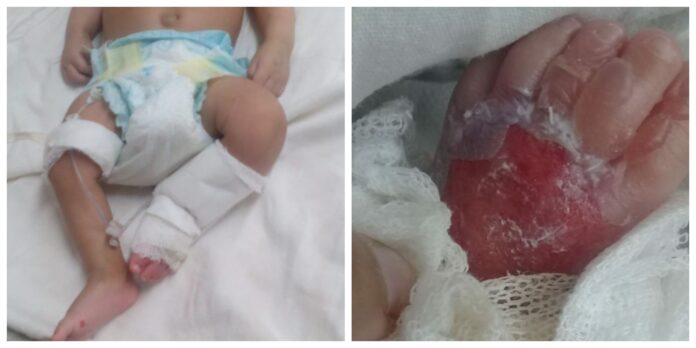 Bebé quemado en Moreno