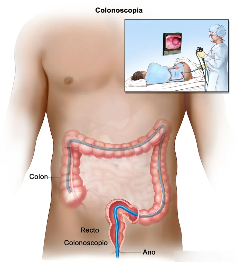 Cáncer colorrectal