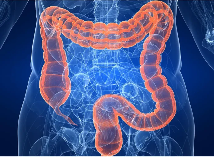 Cáncer colorrectal