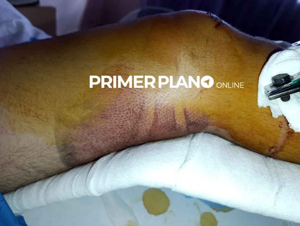 Chocó a 5 motos y huyó en Merlo