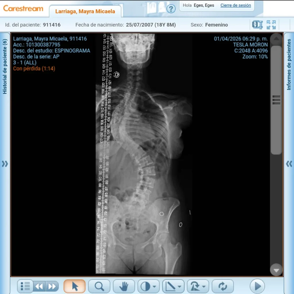 La escoliosis de Mayra Larriaga