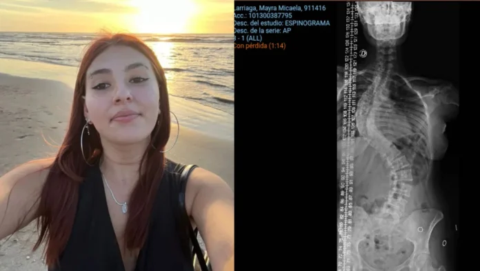 La escoliosis de Mayra Larriaga